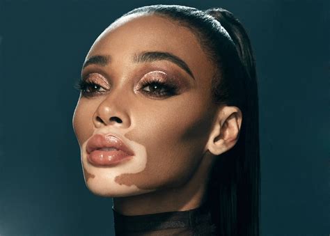 winnie harlow vitiligo spreading